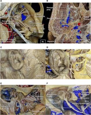 Prognostic Impact of Tumor Extension in Patients With Advanced Temporal Bone Squamous Cell Carcinoma